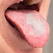 Candidose orale : la langue est duveteuse et blanche à cause du champignon candida albicans